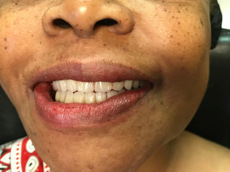 Patient 1after extractions