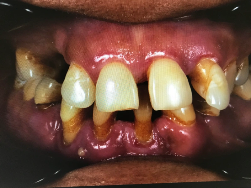 Patient 1before extractions