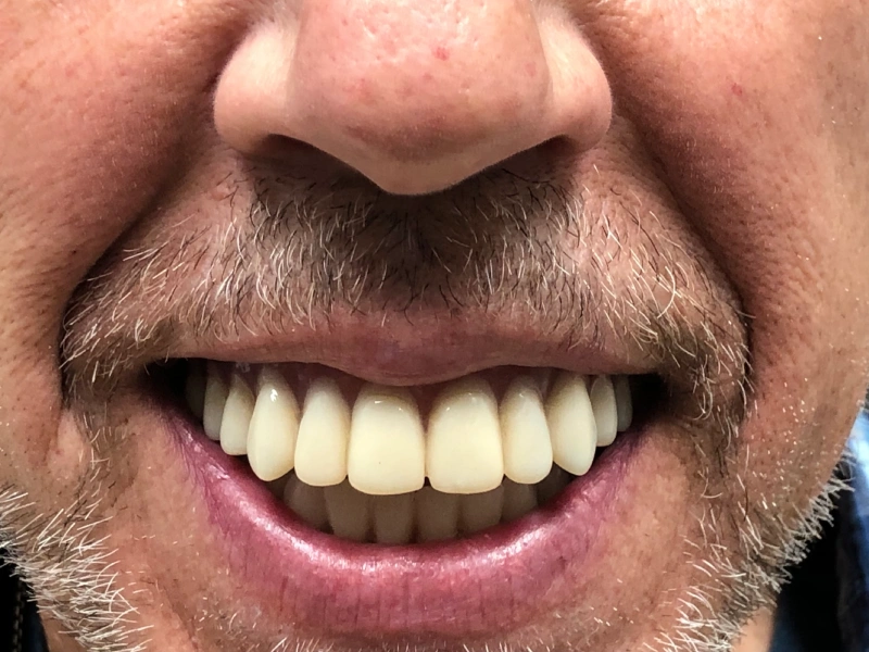 Patient 2 bad upper denture