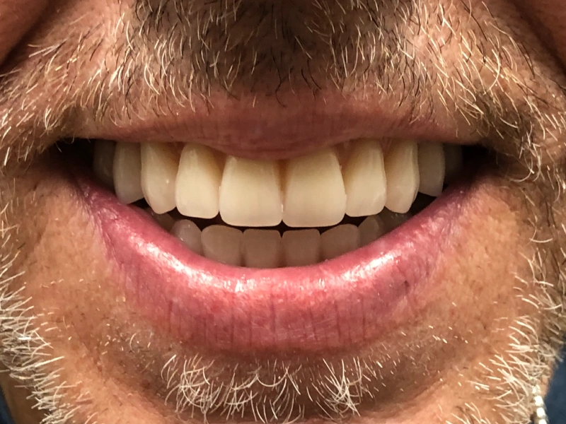 Patient 2 good upper denture