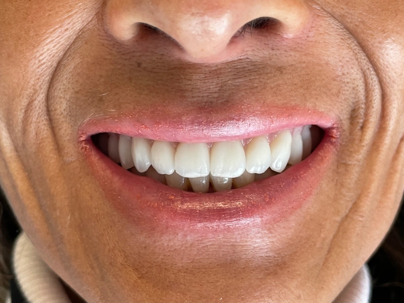 new upper denture Patient 3