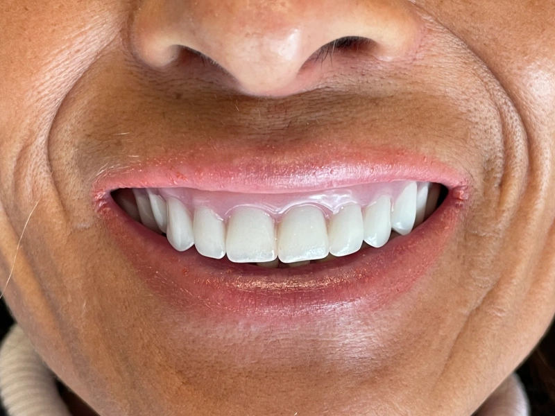 old upper denture Patient 3