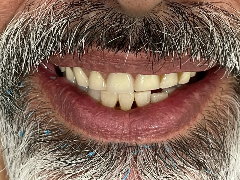 Before upper denturent Patient 4