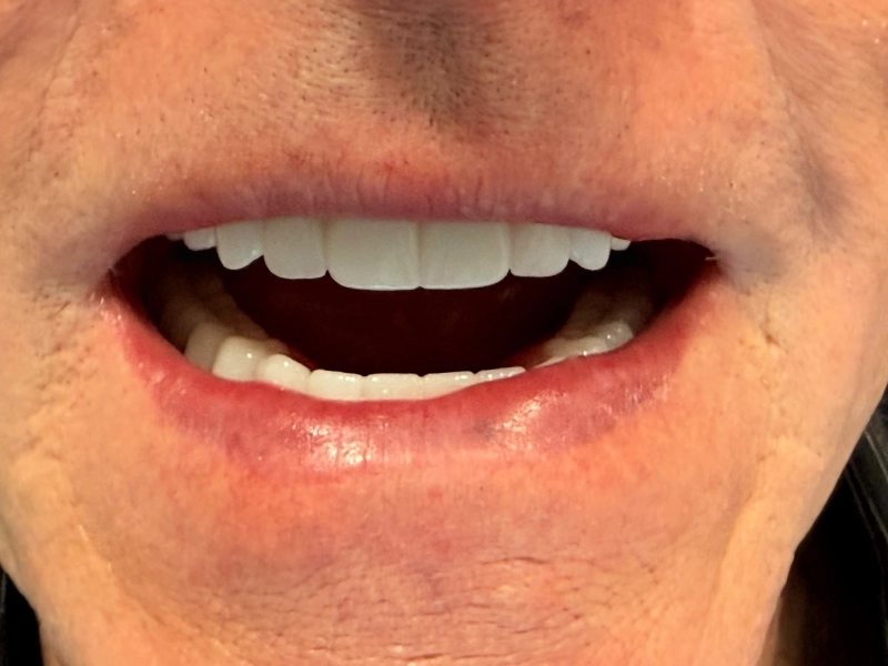 Patient 6 Edentulous patient after dentures