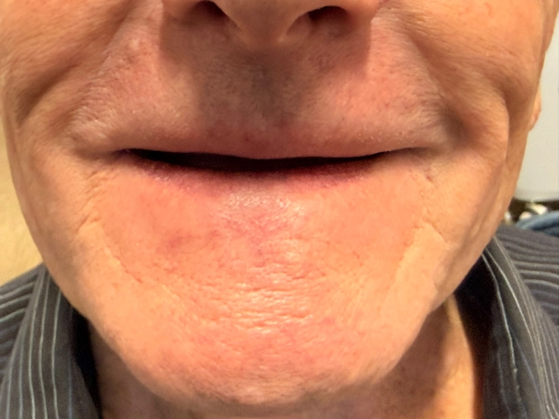 Patient 6 Edentulous patient before dentures