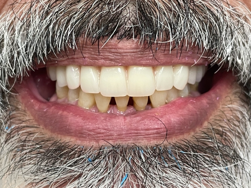 after upper denture Patient 4