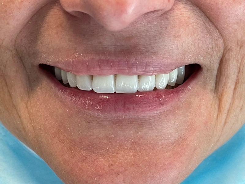 after upper denture Patient 5