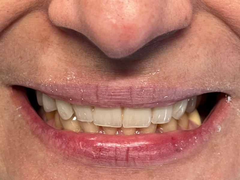 before upper denture Patient 5